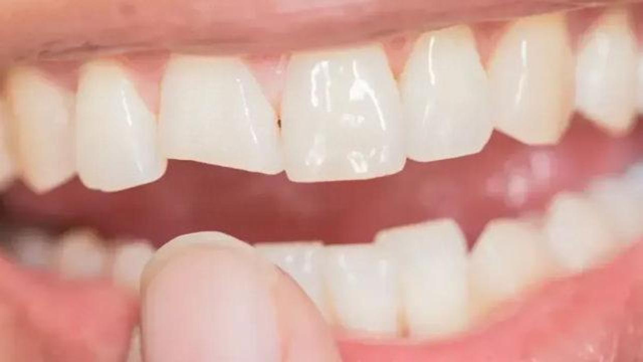 Siz de uzak durun: Dişlerinizi sinsice eritiyor, büyük zarar veriyor!
