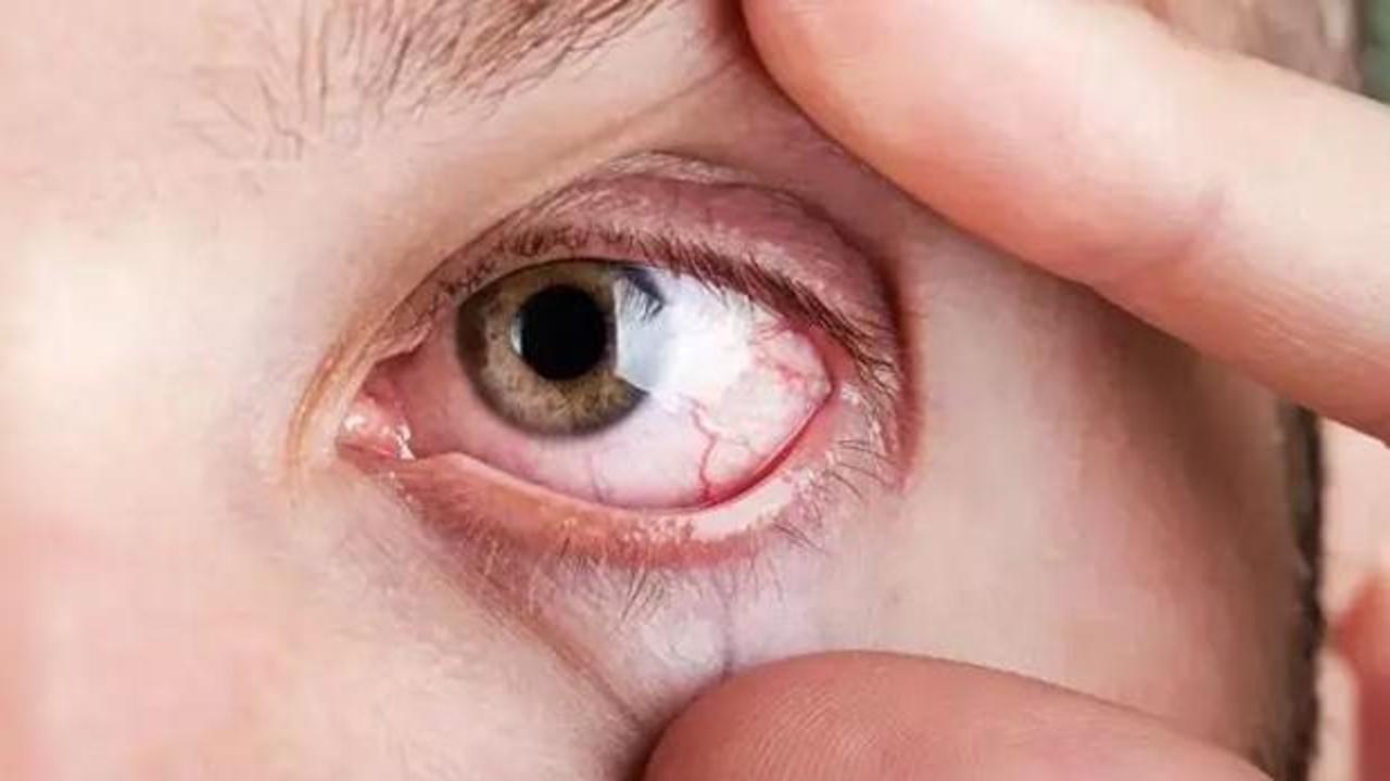 Elinizi bile sürmeyin: Görme kaybına yol açıyor! Acilen bunu yapın